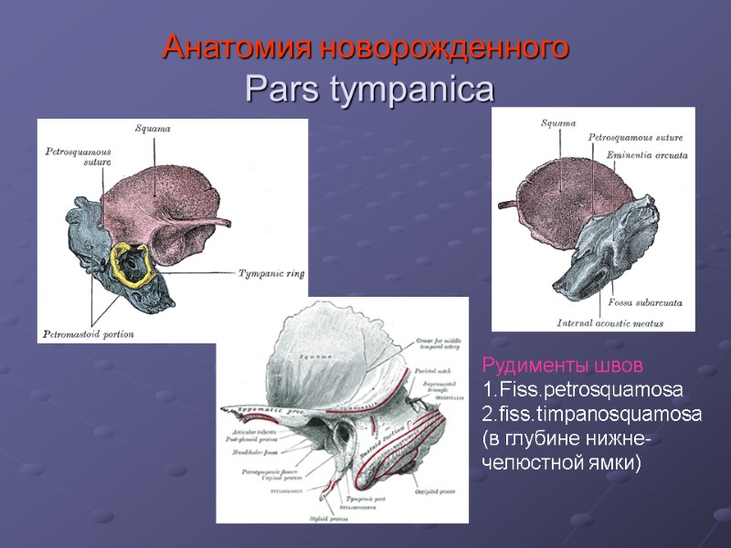Анатомия новорожденного  Pars tympanica Рудименты швов 1.Fiss.petrosquamosa 2.fiss.timpanosquamosa (в глубине нижне-  челюстной